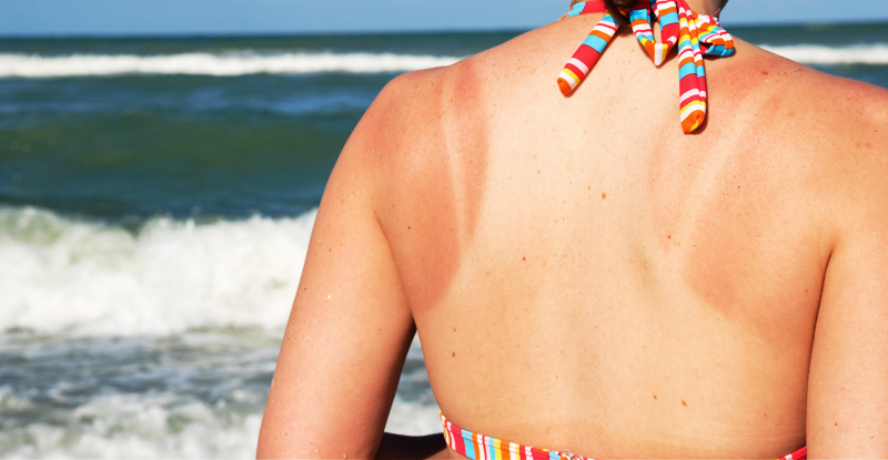 sunburn vs sun poisoning